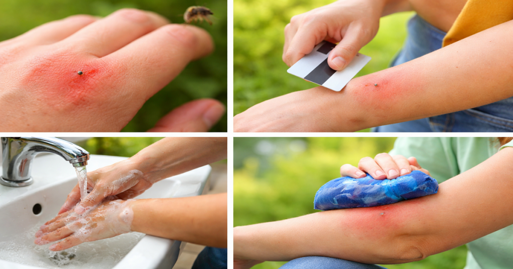 Bee Sting Remedy At Home